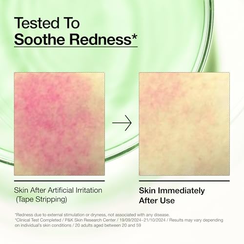 Anua Azelaic Acid 10 Hyaluron Redness Soothing Serum, Facial Serum for Blemish-Prone & Oily-Prone Skin, Lightweight & Hydrating Blemish Care, Hyaluronic Acid, Korean Skincare, 1.01 fl oz.